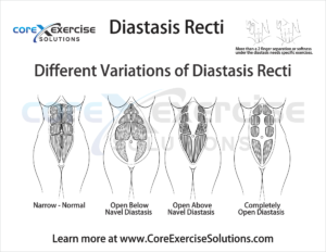 Variations of Diastasis Recti