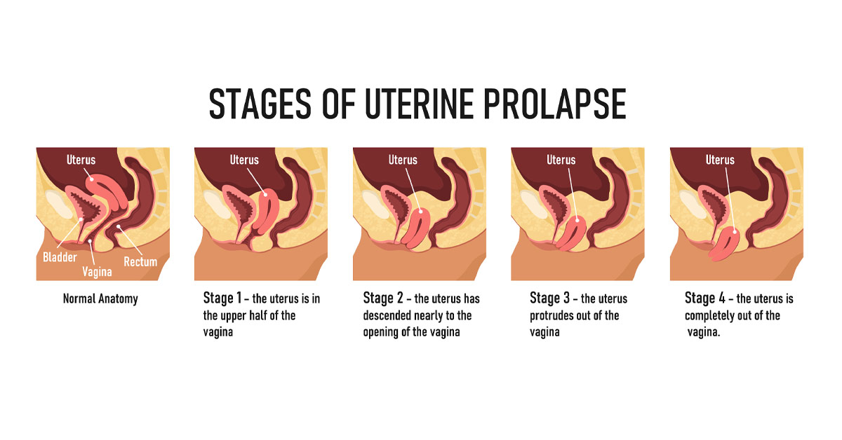 Can I Heal My Prolapse Core Exercise Solutions