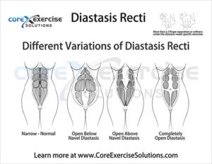 diastasis-2-1024x792