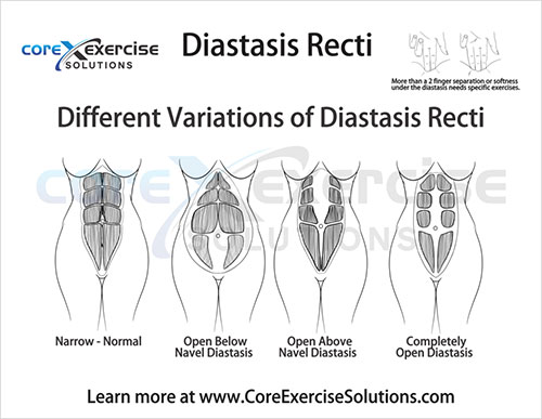 diastasis