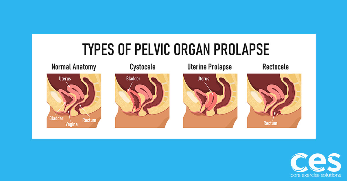 Weightlifter Rectal Prolapse