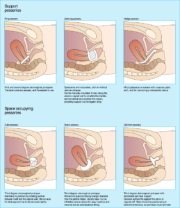 Kinds of Pessary