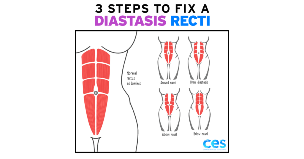 3 Steps to Fix a Diastasis Recti