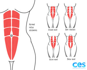 Diastasis Recti