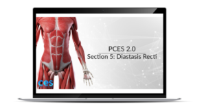 PCES Diastasis Recti Section