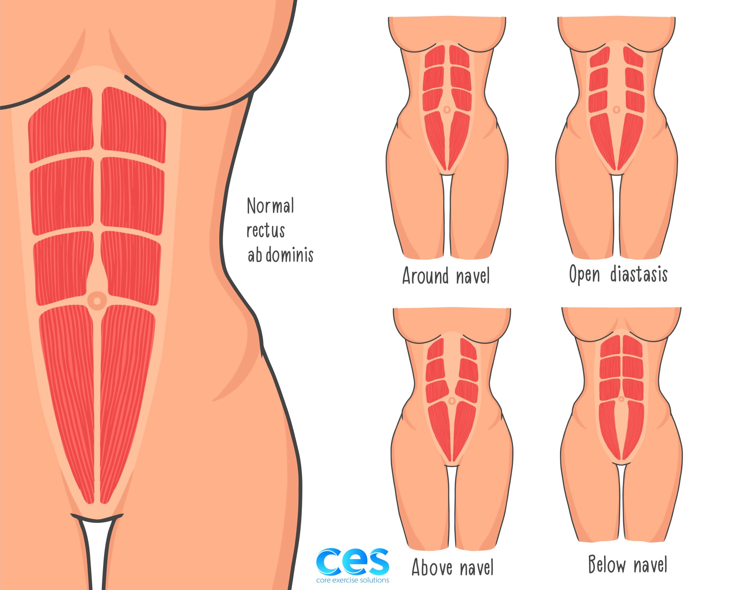 Types of Diastasis Recti