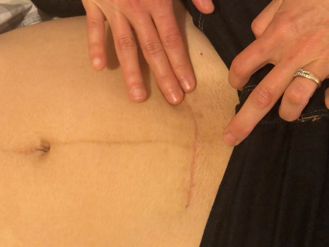 C-Section-Scar-Tissue-Release