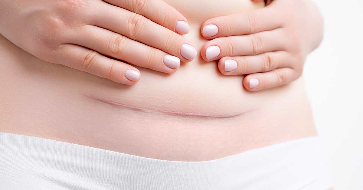 C-Section-Scar