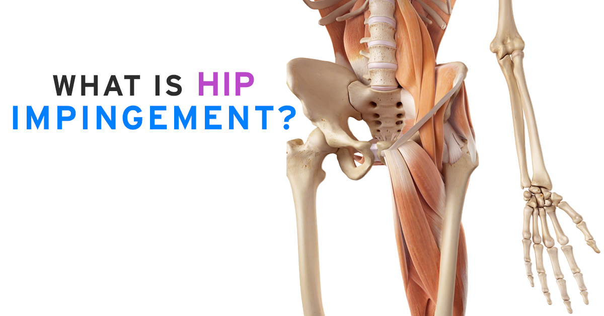 WHAT IS HIP IMPINGEMENT
