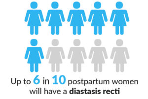 Up to 6 in 10 postpartum women will have a diastasis recti