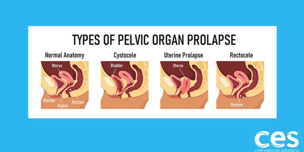 Prolapse Ramblings