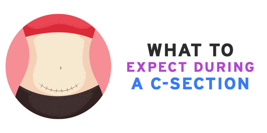 WHAT TO EXPECT DURING A C SECTION
